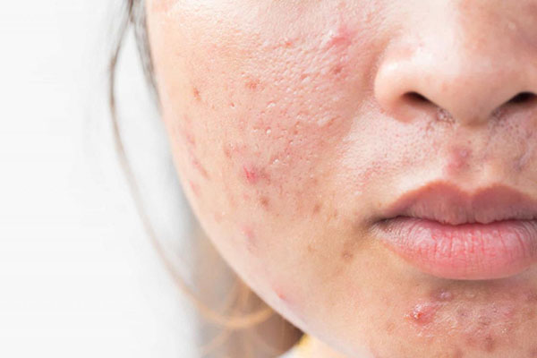 how-to-get-rid-of-acne-scars-quickly-2