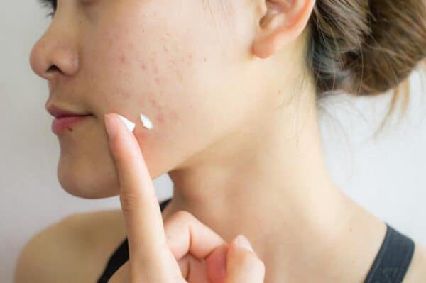 how-to-get-rid-of-acne-scars-quickly