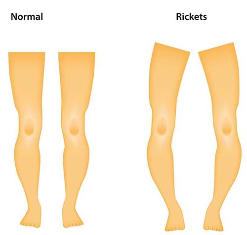does-having-rickets-affect-a-child’s-height